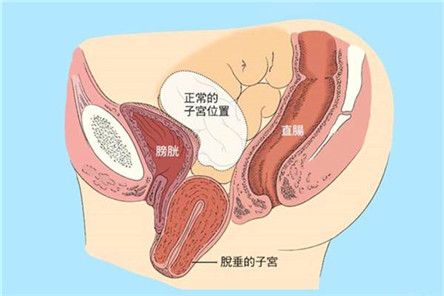 子宫脱垂的临床特点会引起哪些 2022贺州市朱晓瑞科学普及