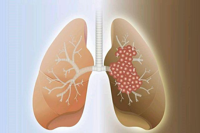 小细胞肺癌是吸烟引起的吗 2012厦门市王姬融科普文章