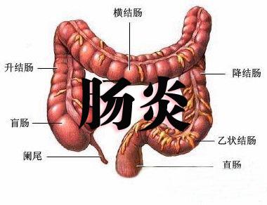 直肠炎会对人体造成哪些伤害呢 2014汕尾市茹卿丽推荐文章