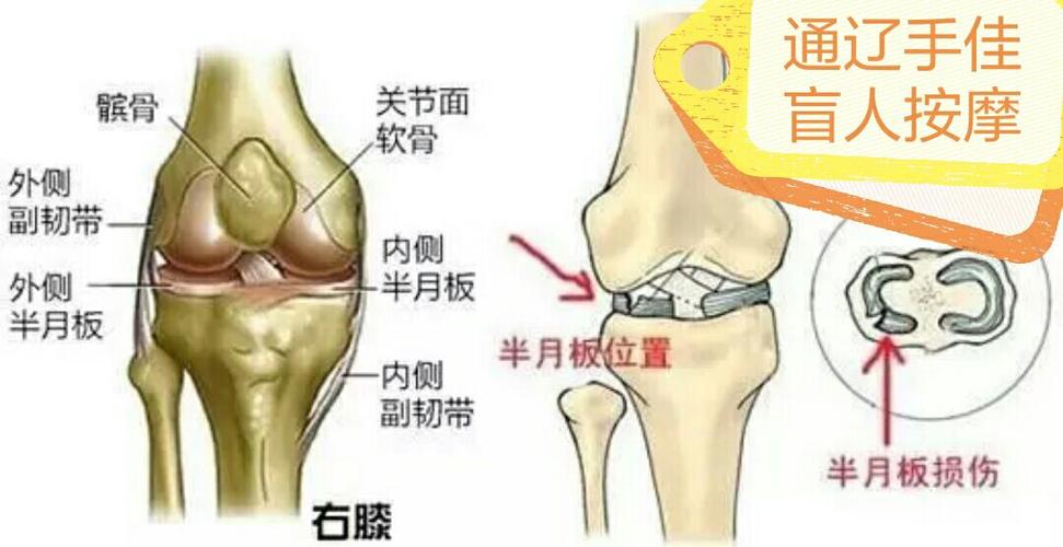 膝关节炎半月板损伤的中药处方 2011大同市任媛菁推荐文章