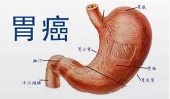 胃痉挛有什么症状表现胃癌晚期 2011焦作市和义娣科学普及