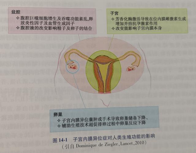 子宫内膜异位症可以吃辅酶q10吗 2010上海市钟艺珠专家推荐