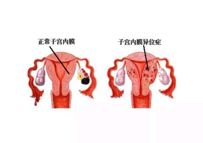 子宫内膜异位症的症状的原因 2008三明市林青礼科普文章