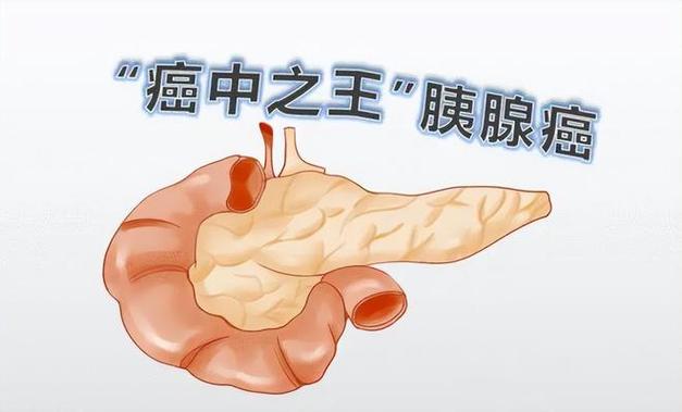 直肠胰腺癌中期能治好吗 绍兴市昌歌翠：关于胰腺癌的专家文章