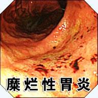 膨出糜烂性胃窦炎的病因有哪些