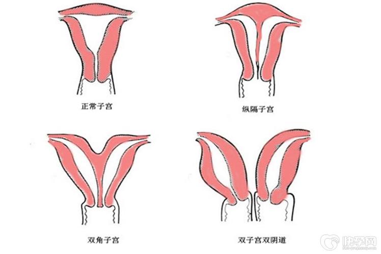 单角子宫畸形手术费用 2012江西金珠枫推荐文章