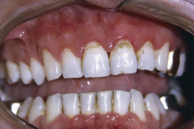牙菌斑并发症状有哪些 2005七台河市曾信昭专家文章