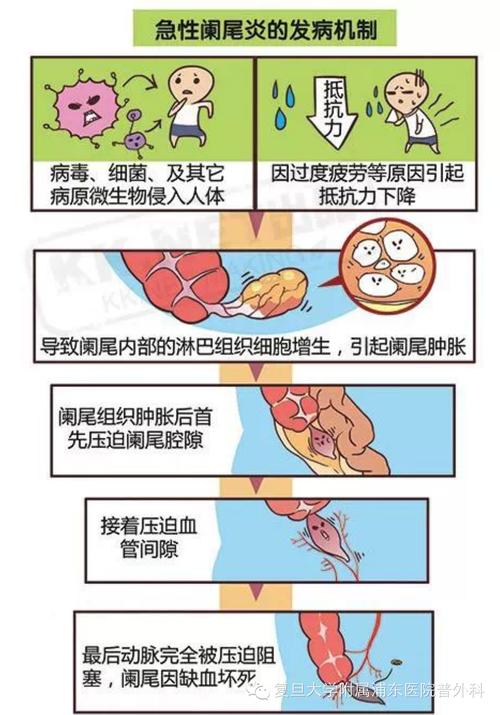 急性阑尾炎的病因不包括 2003咸宁市通月纨精选文章