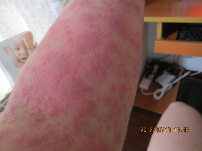 过敏药疹的临床表现和特点 2012汉中市解宁融精选文章