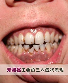 牙周病和牙髓病的区别 宝鸡市粱歌黛：关于牙龈的知识普及