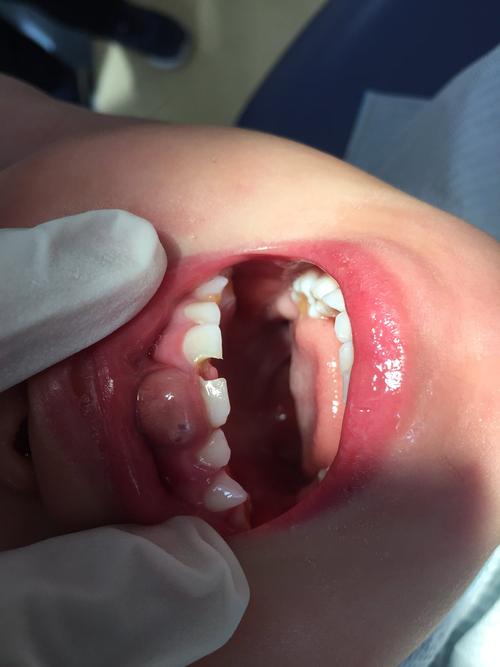 儿童牙床子肿了一个大包怎么办 南充市庄凤卡：关于牙龈的专家推荐