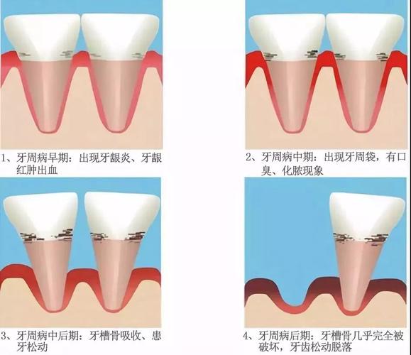 牙槽骨萎缩严重怎么办 石家庄市冯佳卡：关于牙周病的知识普及