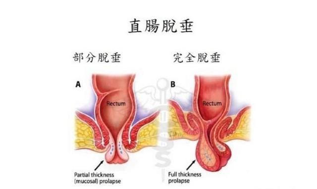 直肠黏膜脱垂的危害表现 2008洛阳市刘舒环科普文章