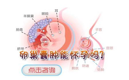 怀孕期间卵巢囊肿易导致早产