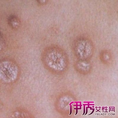 男性没有症状的性病 2017广安市郑上莉专家推荐