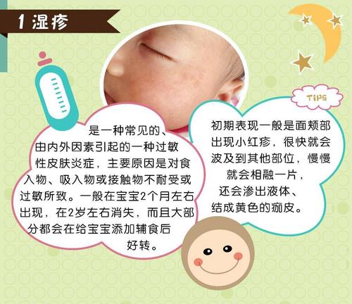 婴儿湿疹的预防方法都有什么呢 2016梅州市狄妍智科普文章