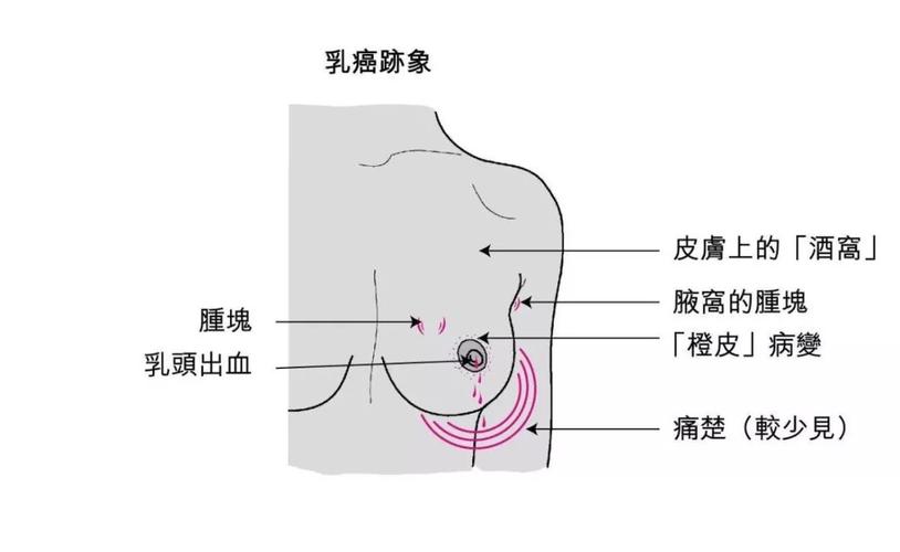 乳腺4c是恶性早期吗 广州市解芳美：关于乳腺癌的知识普及