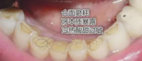 补完牙后牙齿敏感怎么办 2012长沙市强瑾菲专家文章