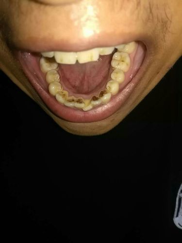 牙齿突然有黑色牙渍是什么原因 2022株洲市吴育怡知识普及
