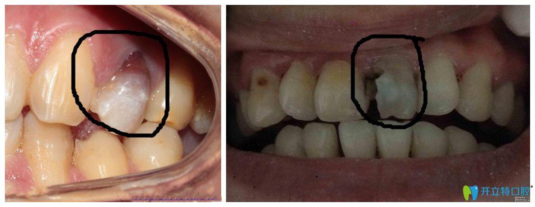 牙齿内部部分发黑牙髓部分坏死 2010吉林吕羽雪专家文章