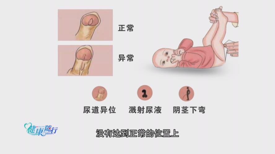 婴儿尿道下裂怎么治疗 2013梧州市车霄娜专家文章