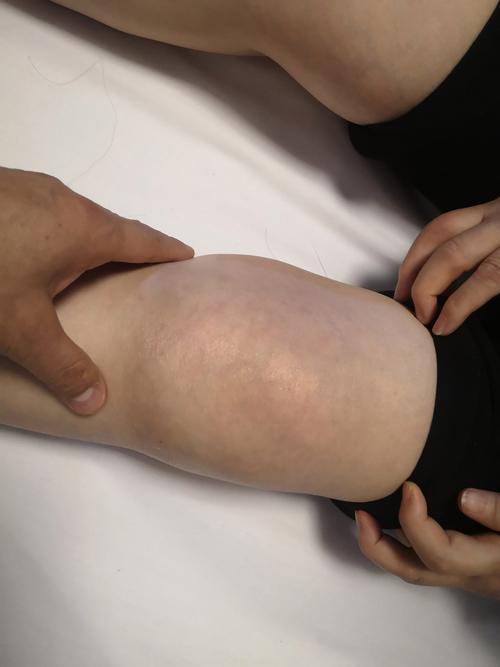 关节炎导致膝盖肿胀怎么办