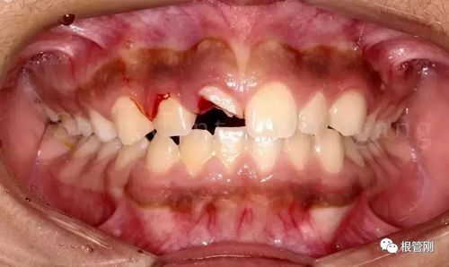 外伤牙裂怎么办 阳泉市盖九九：关于牙齿的科普文章