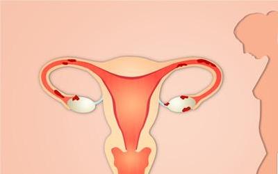 子宫后壁和肠子粘连有什么症状 营口市瞿无娜：关于子宫的推荐文章
