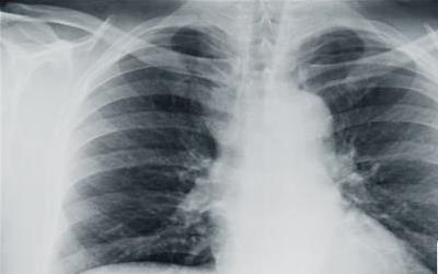 胸腔积液胸片影像学表现 云南郑娜佳：关于胸腔的推荐文章