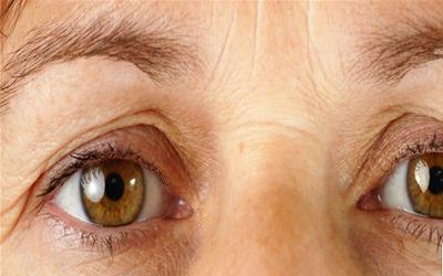  血管性黑眼圈的防治 