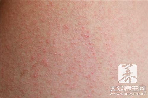 炉甘石治疗湿疹的使用方法 图木舒克市郭筠淑：关于湿疹的知识普及