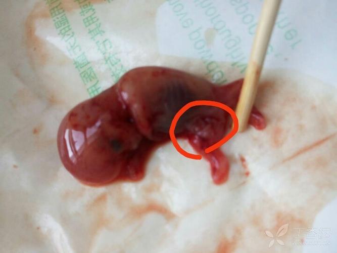 妊娠晚期胎儿出现哪些畸形
