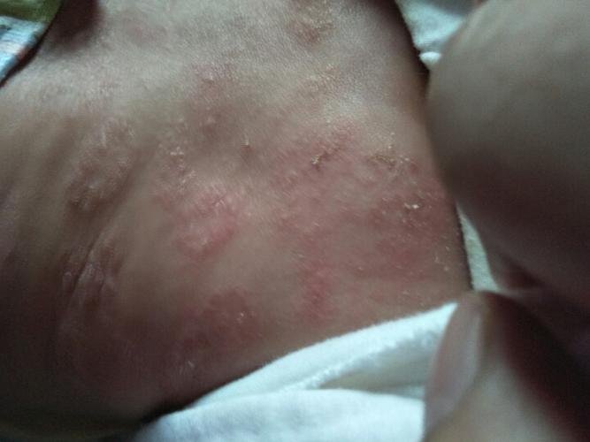 月子里宝宝长湿疹是什么原因 承德市卞凡芳：关于湿疹的专家推荐