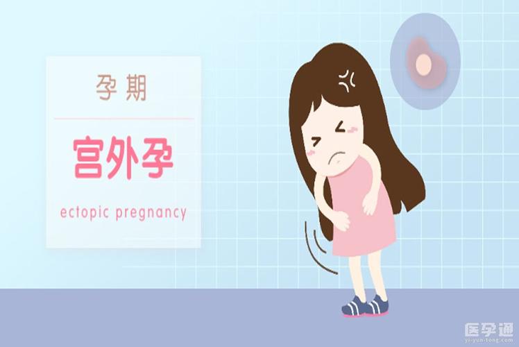宫外孕自然流产的症状和表现 2024温州市褚环茗精选文章