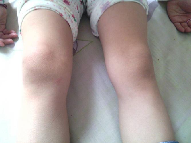 小孩膝关节疼痛的主要原因 济宁市步滢菲：关于膝关节的优选文章