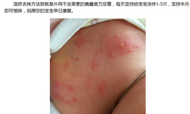 宝宝长湿疹是什么原因引起的呢 2009郑州市边信华科普文章