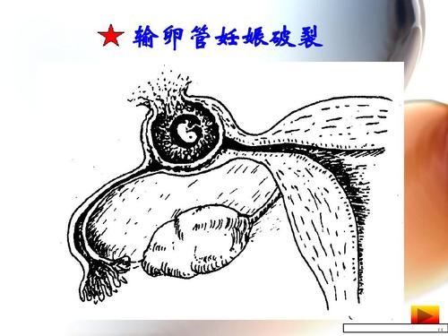 输卵管妊娠破裂的临床表现可有 南川市董晶柔：关于输卵管的知识普及