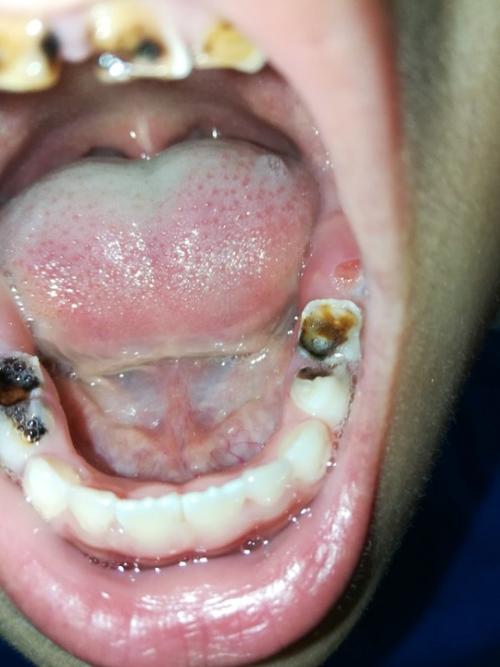 小孩子的牙齿被虫吃掉了怎么办 2011十堰市计芳园优选文章