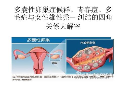引起多囊卵巢综合征原因有哪些 2006娄底市荣义婷推荐文章