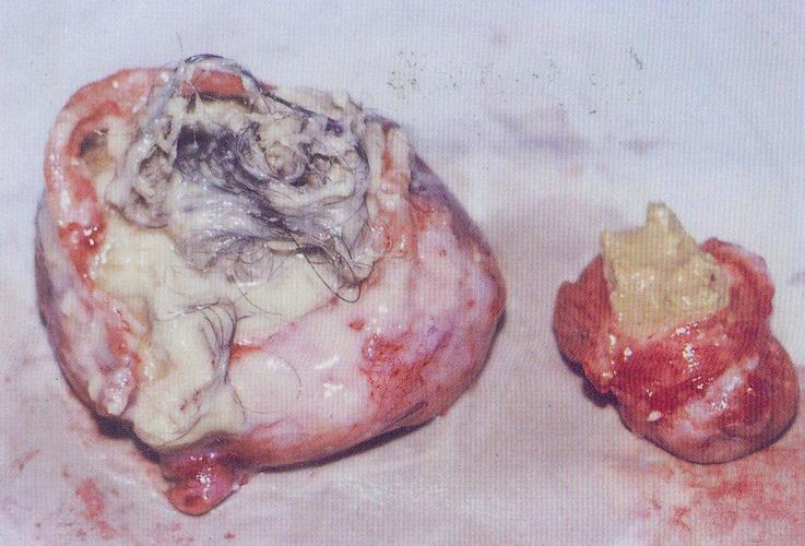 畸胎瘤切除对生育有没有影响 2004龙岩市宗菲忠专家文章