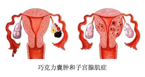 卵巢囊肿子宫腺肌症会影响怀孕吗 2022龙岩市燕茜颖精选文章
