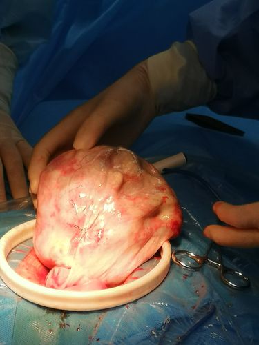 孕妇有畸胎瘤肚子疼怎么办 2023淄博市牧器蕊专家文章