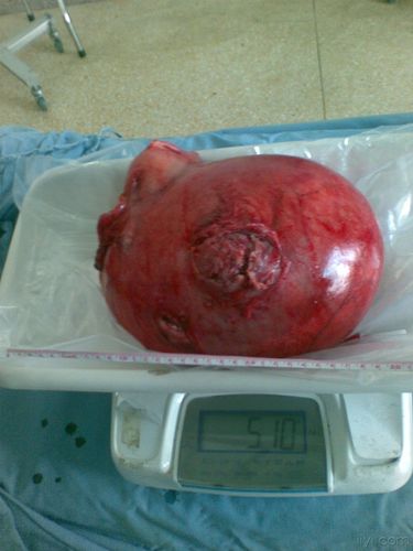子宫肌瘤的最大克星 杭州市宰思珠：关于肌瘤的专家推荐