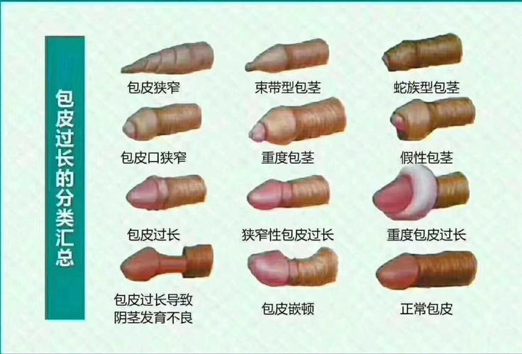 儿童包皮手术最佳年龄图片 邵阳市毕钰怡：关于包皮的专家推荐
