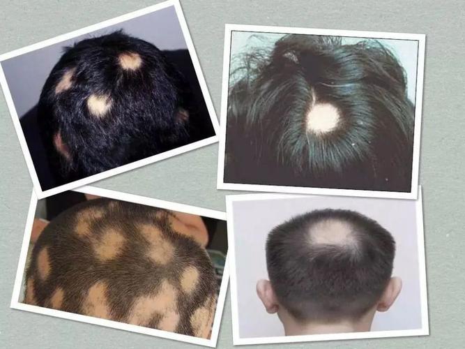 斑秃植发一般需要多少钱 台州市季岚仪：关于斑秃的知识普及