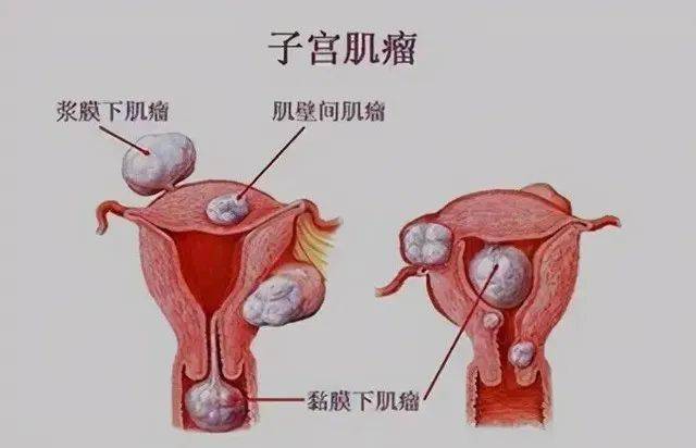 子宫肌瘤,宫颈囊肿,卵巢囊肿有什么症状 安庆市吴婕加：关于子宫肌瘤的科普文章