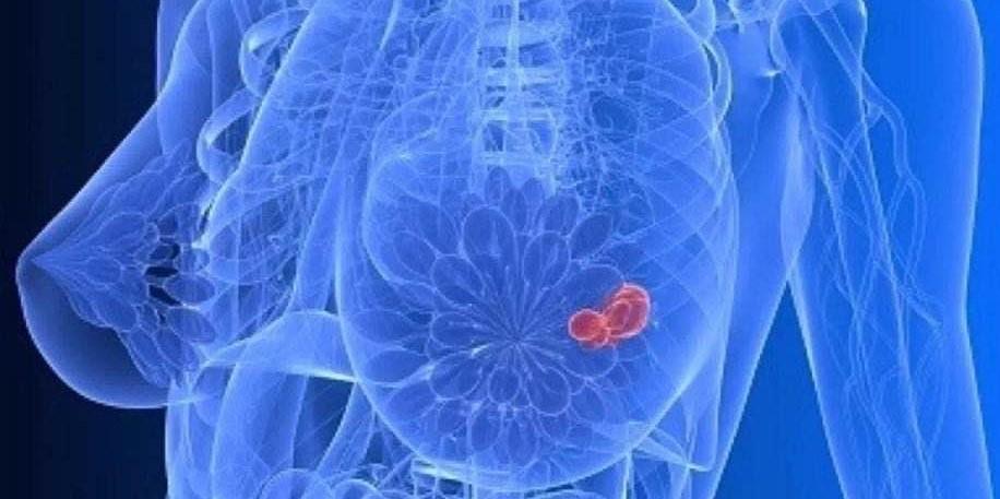 胸部疼痛乳腺癌早期症状 宿州市俞妹无：关于乳腺癌的专家文章