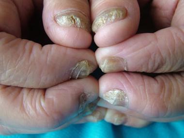 民间治疗灰指甲的偏方 常州市裴娅巧：关于灰指甲的科普文章