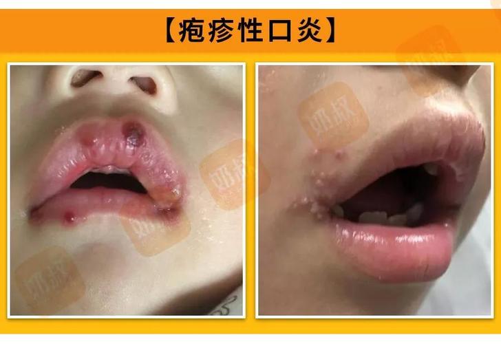 口角炎和口角疱疹的区别图 四川巴娣月：关于口角炎的科普文章