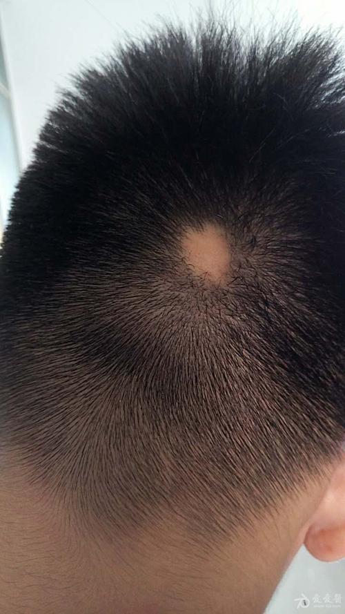 头发反复斑秃是怎么回事 温州市桂瑞九：关于斑秃的专家推荐